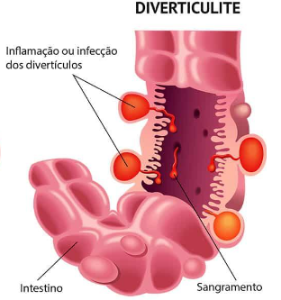 Diverticulose e Diverticulite