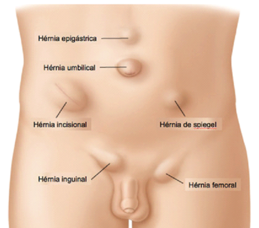 Hérnias da parede abdominal