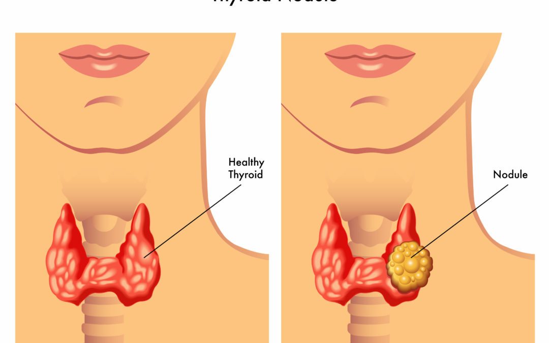 Nódulos de Tireoide